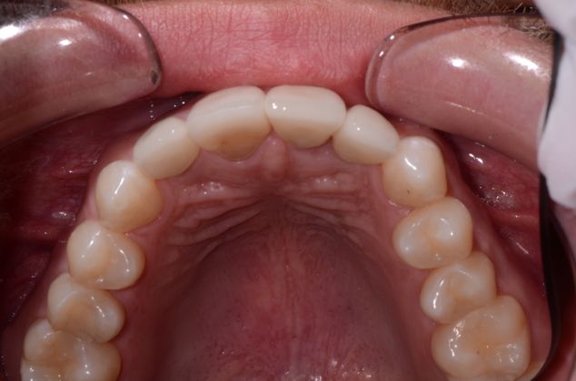 Dental Implants: Case 3 - After