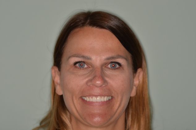 Porcelain Veneers: Case 2 - After