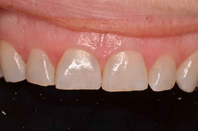 Porcelain Veneers: Case 2 - Before