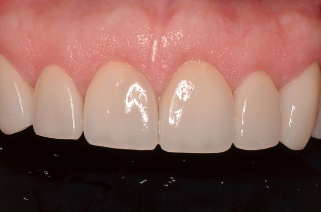 Porcelain Veneers: Case 2 - After
