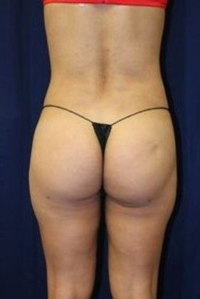 Liposuction & Safe Lipo: Case 10 - After