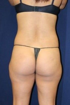 Liposuction & Safe Lipo: Case 10 - Before