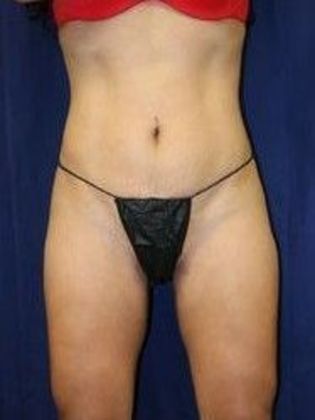 Liposuction & Safe Lipo Case 10 - After