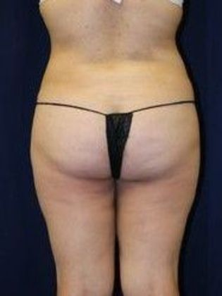 Liposuction & Safe Lipo Case 11 - After