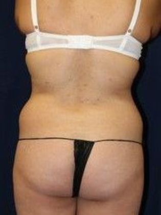 Liposuction & Safe Lipo Case 11 - Before