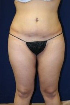 Liposuction & Safe Lipo: Case 11 - After