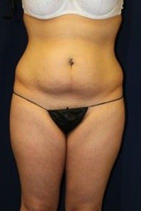 Liposuction & Safe Lipo: Case 11 - Before