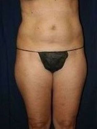 Liposuction & Safe Lipo: Case 12 - Before