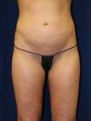 Liposuction & Safe Lipo Case 14 - After