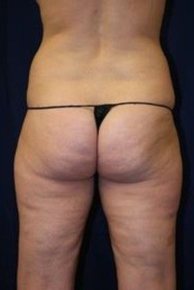 Liposuction & Safe Lipo: Case 14 - Before