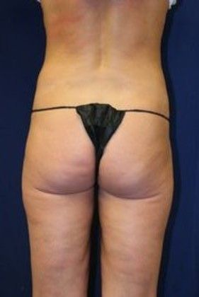 Liposuction & Safe Lipo: Case 14 - After