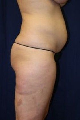 Liposuction & Safe Lipo: Case 14 - Before