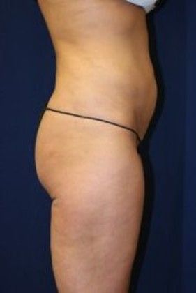 Liposuction & Safe Lipo: Case 14 - After