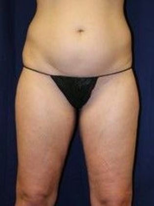 Liposuction & Safe Lipo Case 14 - Before
