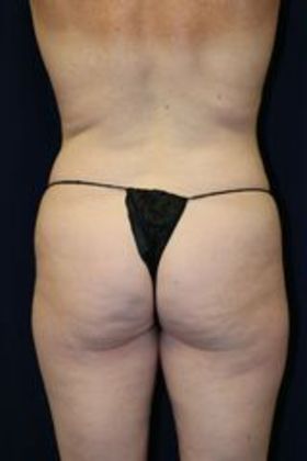 Liposuction & Safe Lipo: Case 15 - Before