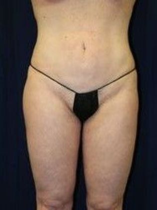 Liposuction & Safe Lipo: Case 15 - After