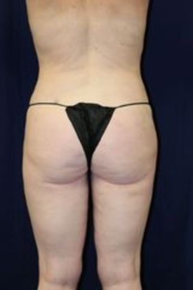 Liposuction & Safe Lipo: Case 15 - After
