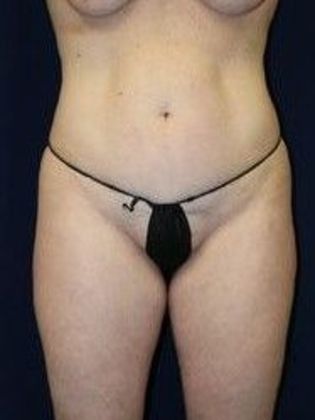 Liposuction & Safe Lipo: Case 15 - Before