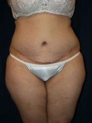 Tummy Tuck*: Case 11 - After