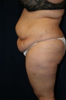 Tummy Tuck*: Case 11 - Before