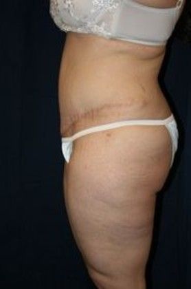 Tummy Tuck*: Case 11 - After