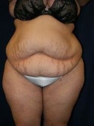 Tummy Tuck*: Case 11 - Before