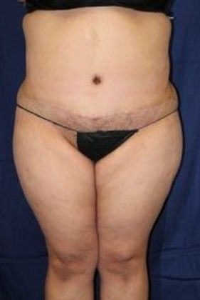 Tummy Tuck*: Case 15 - After