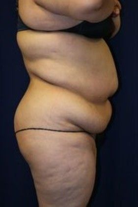 Tummy Tuck*: Case 15 - Before