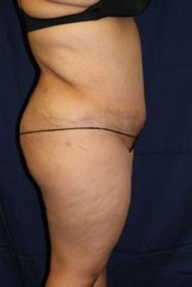 Tummy Tuck*: Case 15 - After