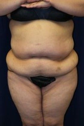 Tummy Tuck*: Case 15 - Before