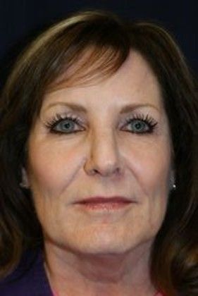 Cosmetic Injectables & Fillers*: Case 20 Lip & Cheek Filler - Before