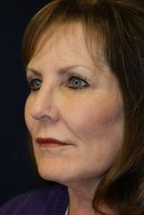 Cosmetic Injectables & Fillers*: Case 20 Lip & Cheek Filler - After