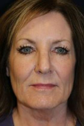 Cosmetic Injectables & Fillers*: Case 20 Lip & Cheek Filler - After