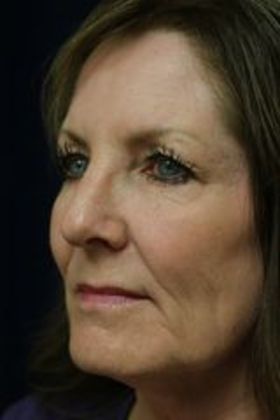 Cosmetic Injectables & Fillers*: Case 20 Lip & Cheek Filler - Before