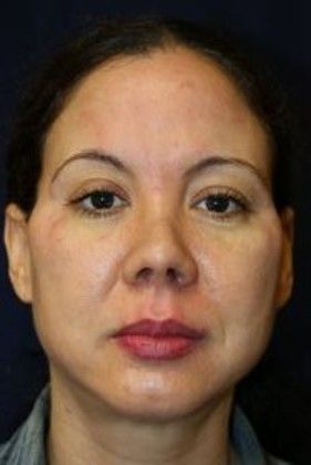 Cosmetic Injectables & Fillers*: Case 21 Cheek Filler - After