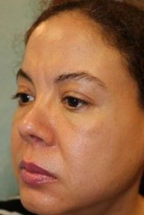 Cosmetic Injectables & Fillers*: Case 21 Cheek Filler - Before