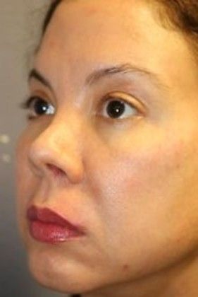 Cosmetic Injectables & Fillers*: Case 21 Cheek Filler - After