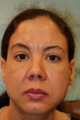 Cosmetic Injectables & Fillers*: Case 21 Cheek Filler - Before