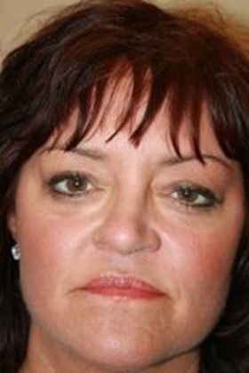 Cosmetic Injectables & Fillers*: Case 22 Cheek Filler - After