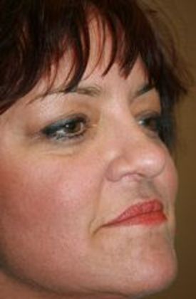 Cosmetic Injectables & Fillers*: Case 22 Cheek Filler - After