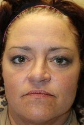 Cosmetic Injectables & Fillers*: Case 22 Cheek Filler - Before