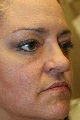 Cosmetic Injectables & Fillers*: Case 22 Cheek Filler - Before