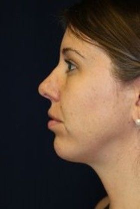 Chin Augmentation*: Case 2 - After
