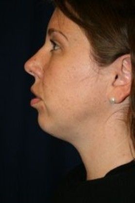 Chin Augmentation*: Case 2 - Before