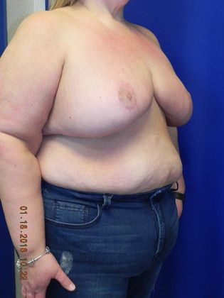 Breast Reduction: Case 28 (19321) - Before