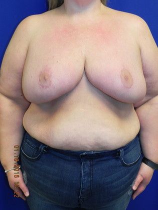 Breast Reduction Case 28 (19321) - After