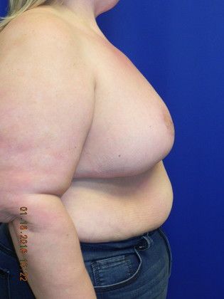 Breast Reduction: Case 28 (19321) - After