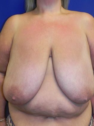 Breast Reduction Case 28 (19321) - Before