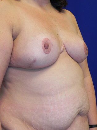Breast Reduction: Case 29 (19509) - After