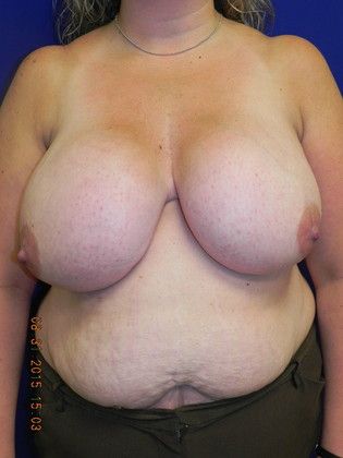 Breast Reduction: Case 29 (19509) - Before